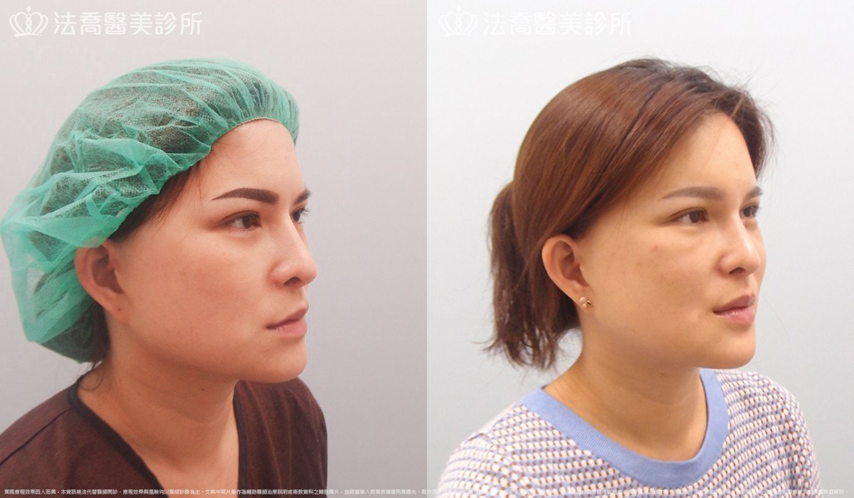 法喬醫美診所,邱浚彥,人工骨下巴