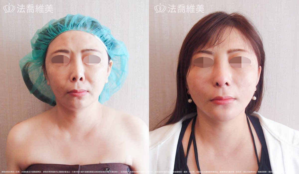 法喬醫美診所,邱浚彥,自體肋骨隆鼻