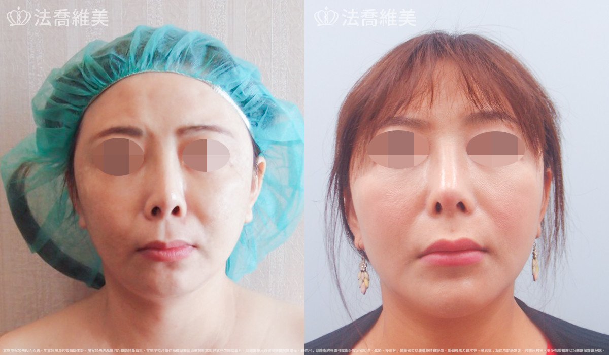 法喬醫美診所,邱浚彥,自體肋骨隆鼻