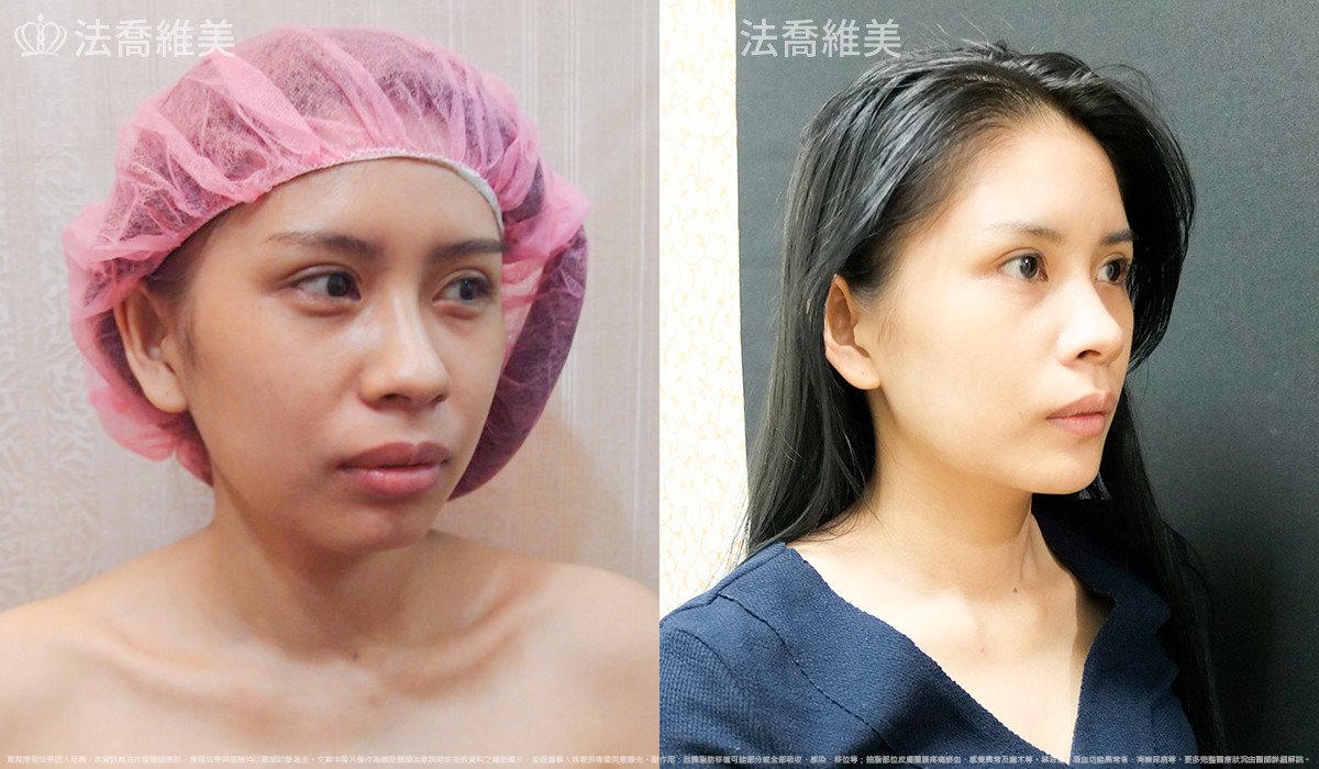 法喬醫美診所,邱浚彥,人工骨下巴