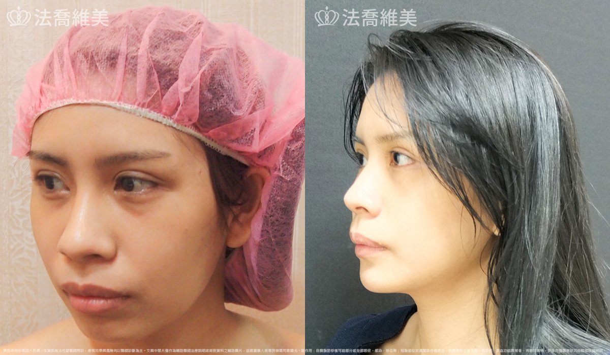 法喬醫美診所,邱浚彥,人工骨下巴