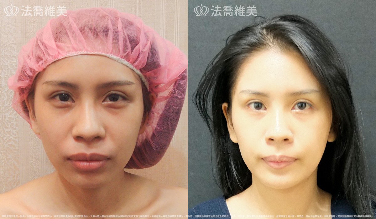 法喬醫美診所,邱浚彥,人工骨下巴