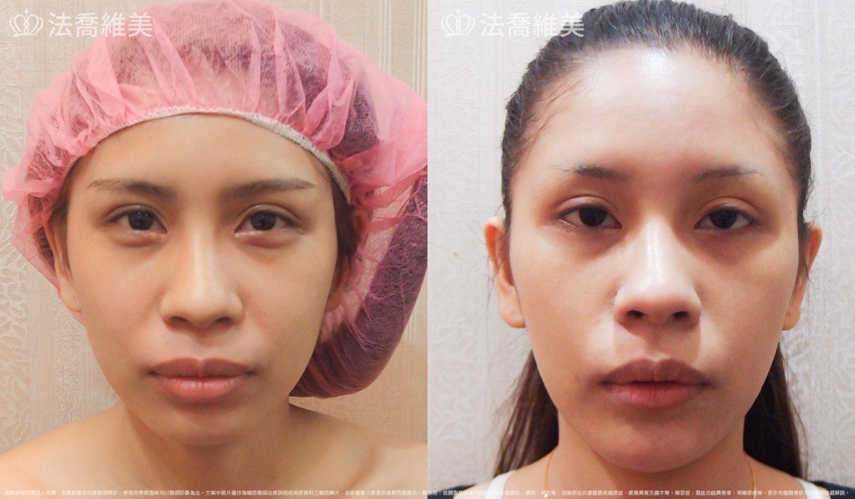 法喬醫美診所,邱浚彥,人工骨下巴