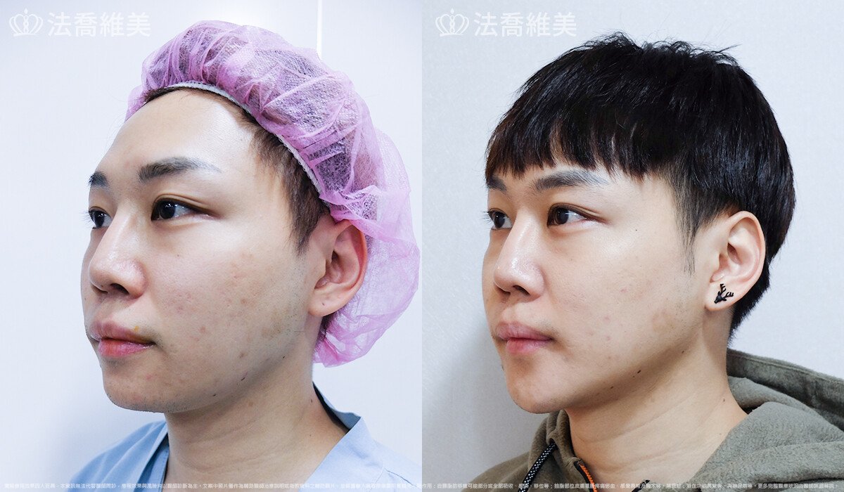自體肋骨隆鼻