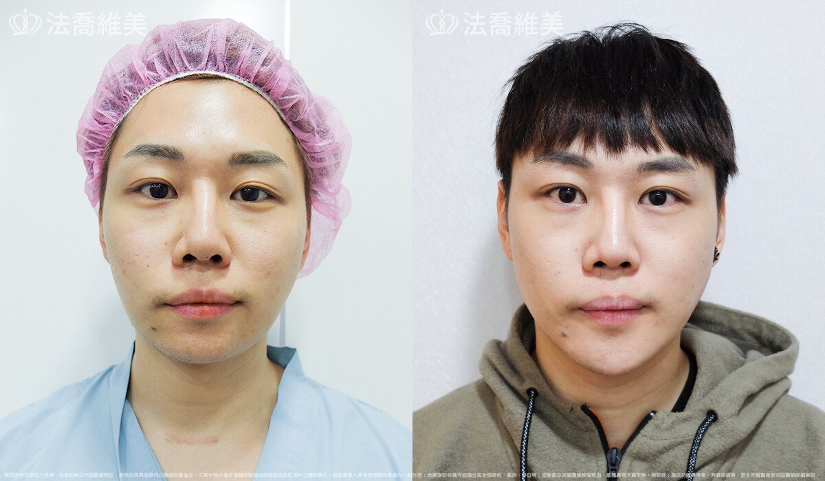 自體肋骨隆鼻