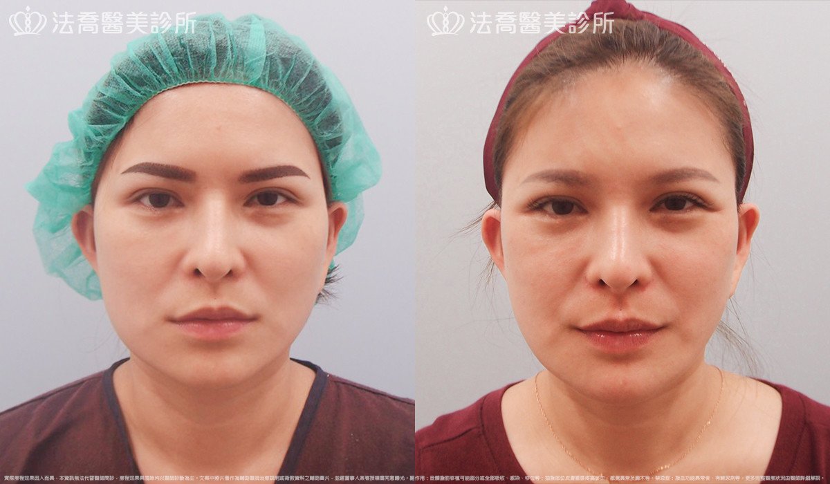 法喬醫美診所,邱浚彥,下顎角削骨