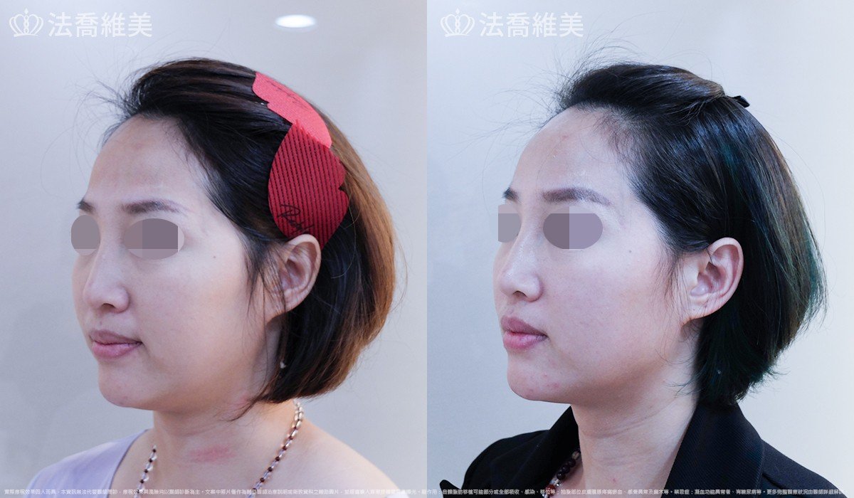 玻尿酸填補額頭 / 太陽穴