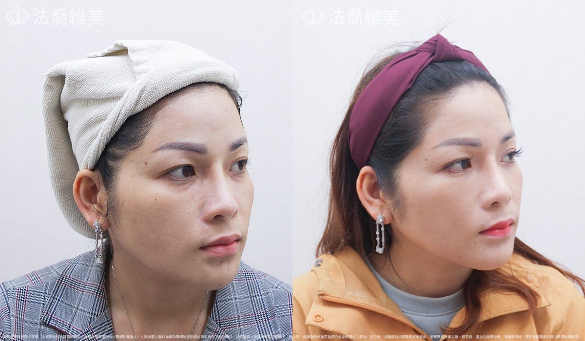 稚齡針