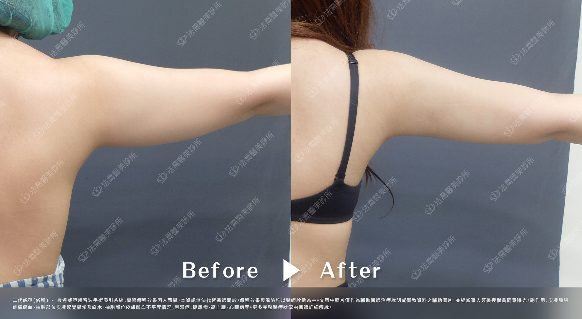 法喬醫美診所,威塑手臂環抽