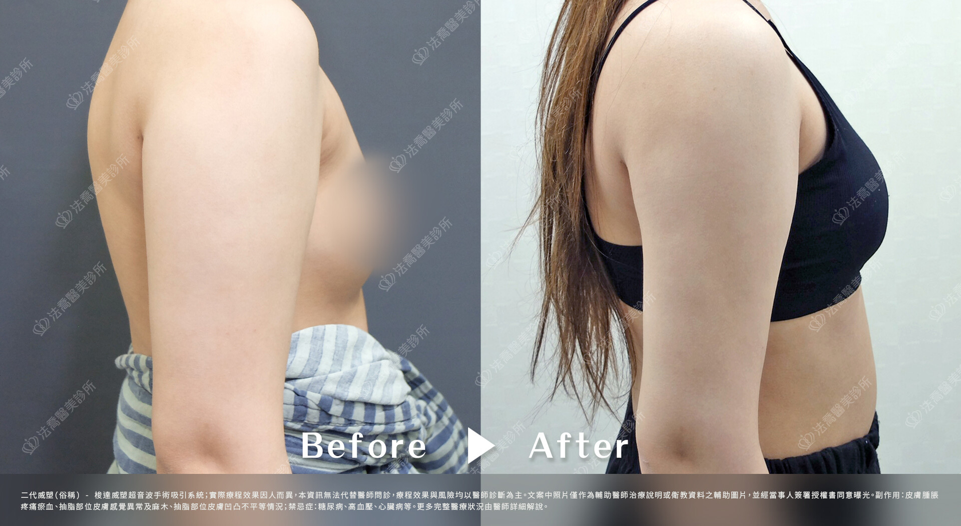 法喬醫美診所,威塑手臂環抽