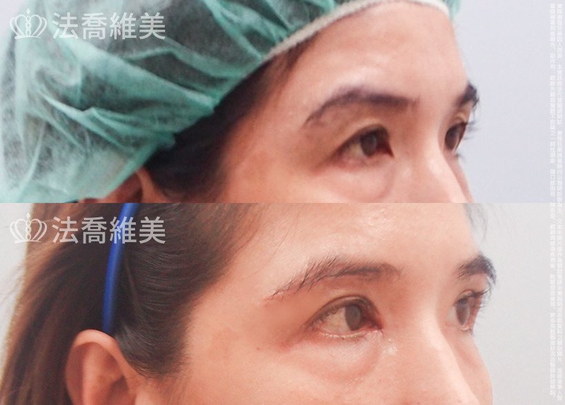 法喬醫美診所,邱浚彥,切眉