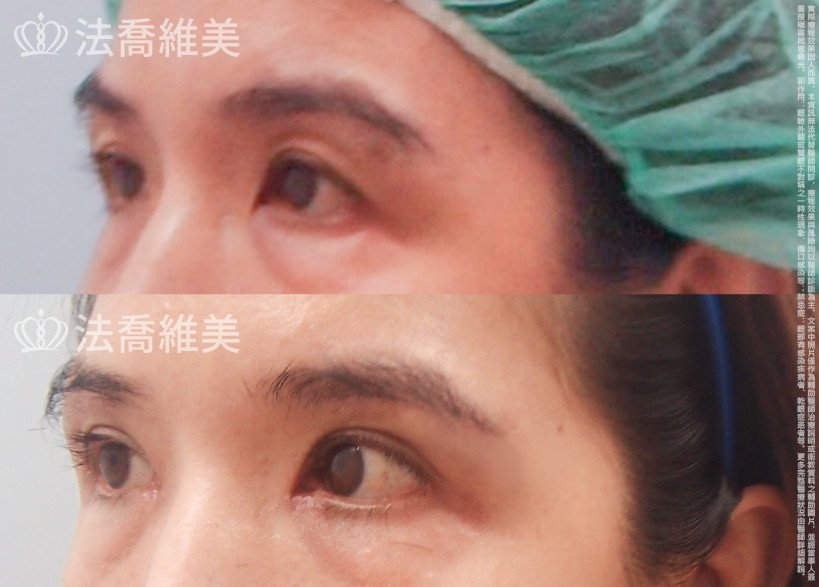 法喬醫美診所,邱浚彥,切眉