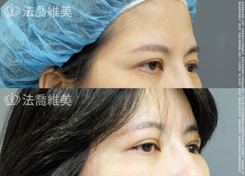 法喬醫美診所,邱浚彥,切眉