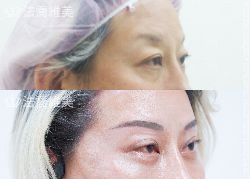 法喬醫美診所 邱浚彥醫師,切眉