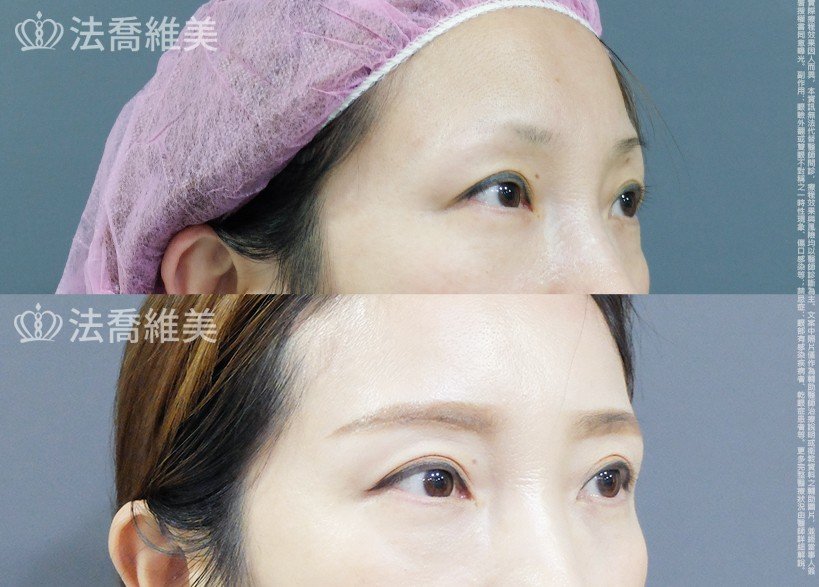 眉部手術