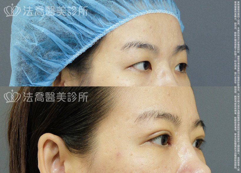 法喬醫美診所,邱浚彥,割雙眼皮