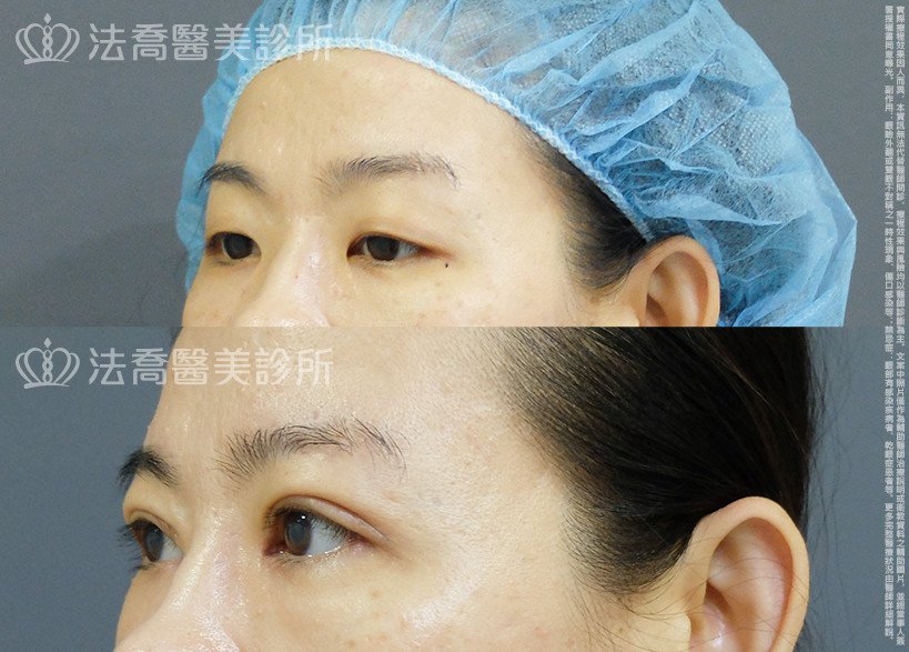 法喬醫美診所,邱浚彥,割雙眼皮