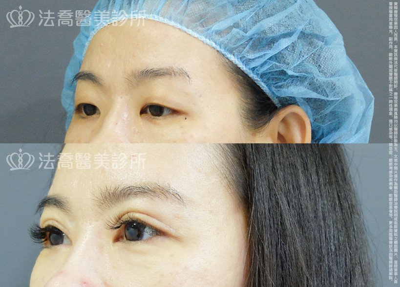 法喬醫美診所,邱浚彥,割雙眼皮