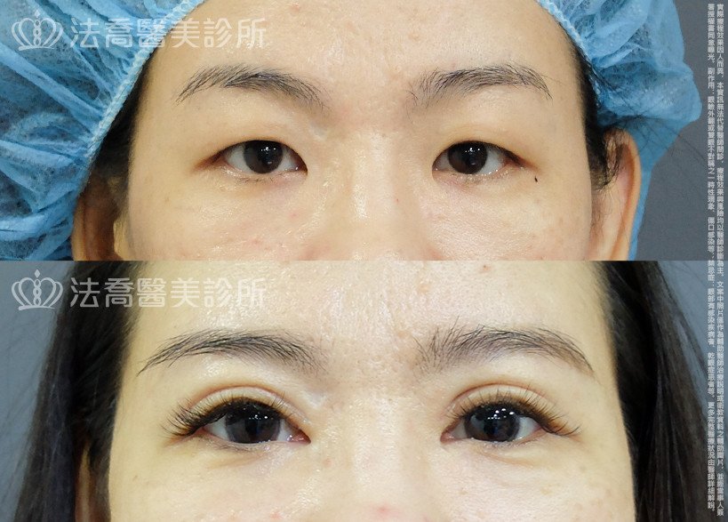 法喬醫美診所,邱浚彥,割雙眼皮