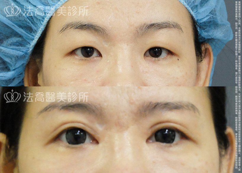 法喬醫美診所,邱浚彥,割雙眼皮