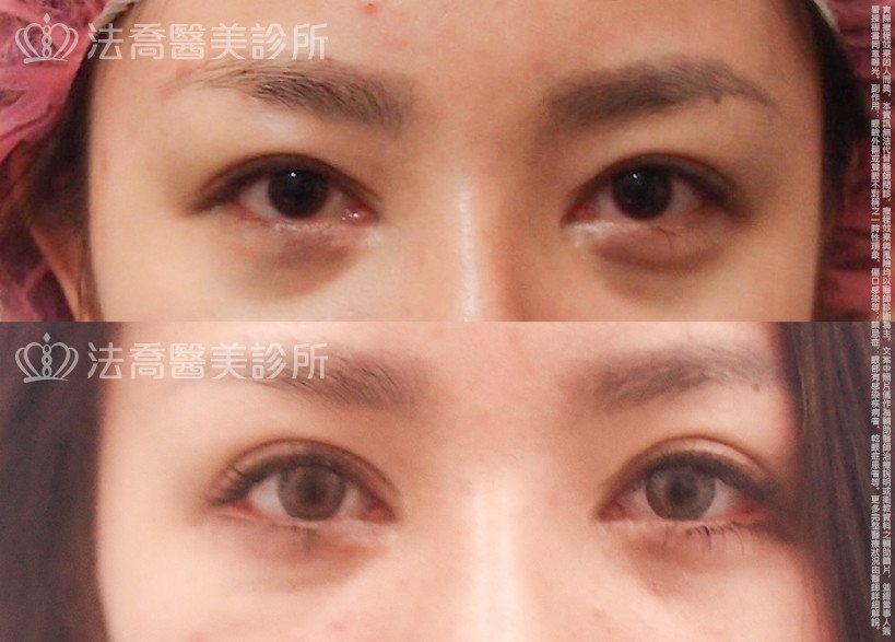 法喬醫美診所,邱浚彥,割雙眼皮,開眼頭,開眼尾