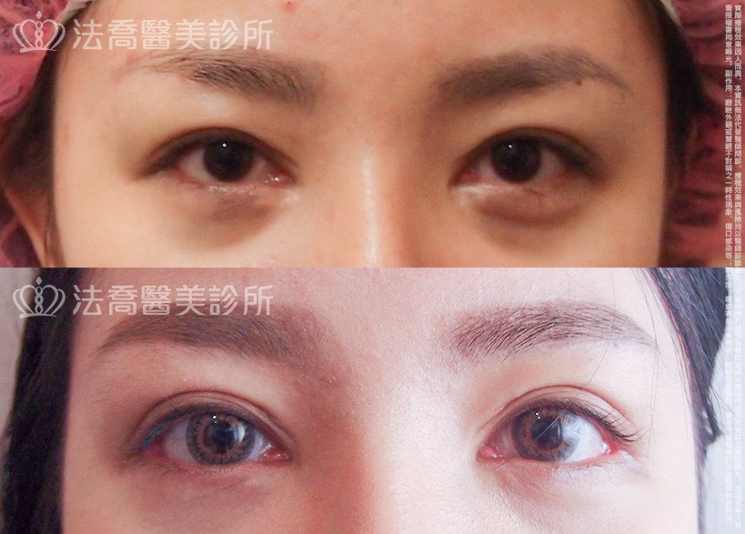 法喬醫美診所,邱浚彥,割雙眼皮,開眼頭,開眼尾