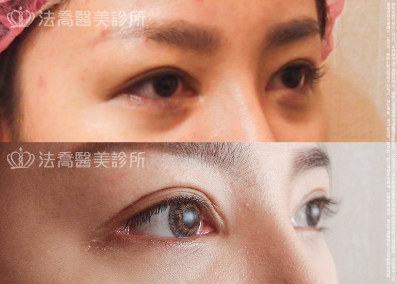 法喬醫美診所,邱浚彥,割雙眼皮,開眼頭,開眼尾