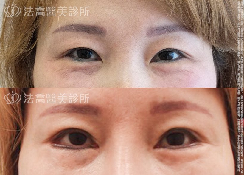 法喬醫美診所,邱浚彥,割雙眼皮,開眼頭,開眼尾