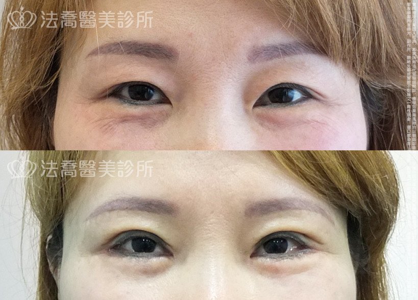法喬醫美診所,邱浚彥,割雙眼皮,開眼頭,開眼尾