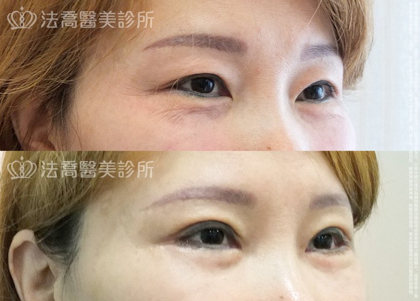 法喬醫美診所,邱浚彥,割雙眼皮,開眼頭,開眼尾