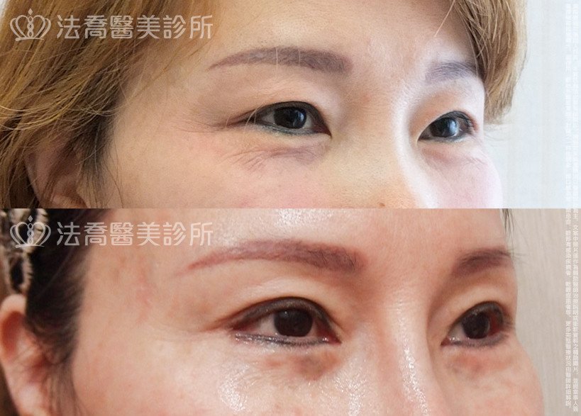 法喬醫美診所,邱浚彥,割雙眼皮,開眼頭,開眼尾