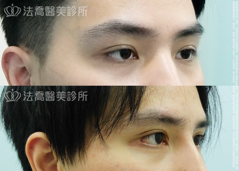 法喬醫美診所,邱浚彥,割雙眼皮,開眼頭,開眼尾