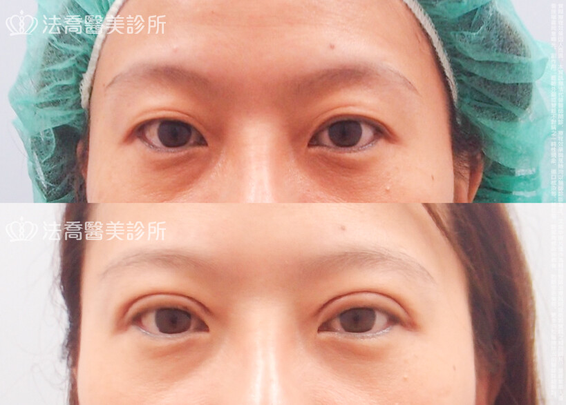 法喬醫美診所,邱浚彥,割雙眼皮