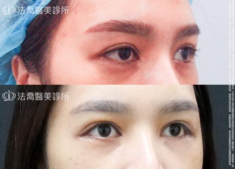 法喬醫美診所,邱浚彥,割雙眼皮,眼瞼肌提拉術,開眼頭,開眼尾