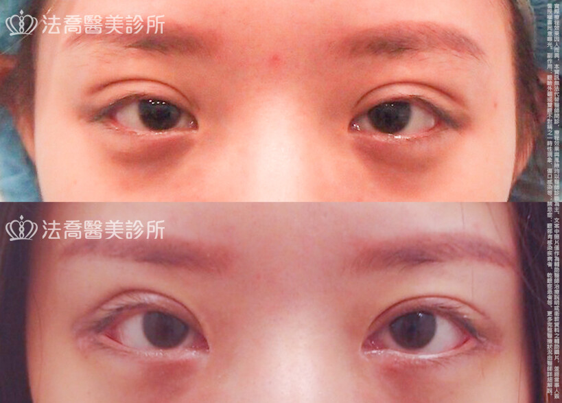 法喬醫美診所,邱浚彥,割雙眼皮,開眼頭,開眼尾