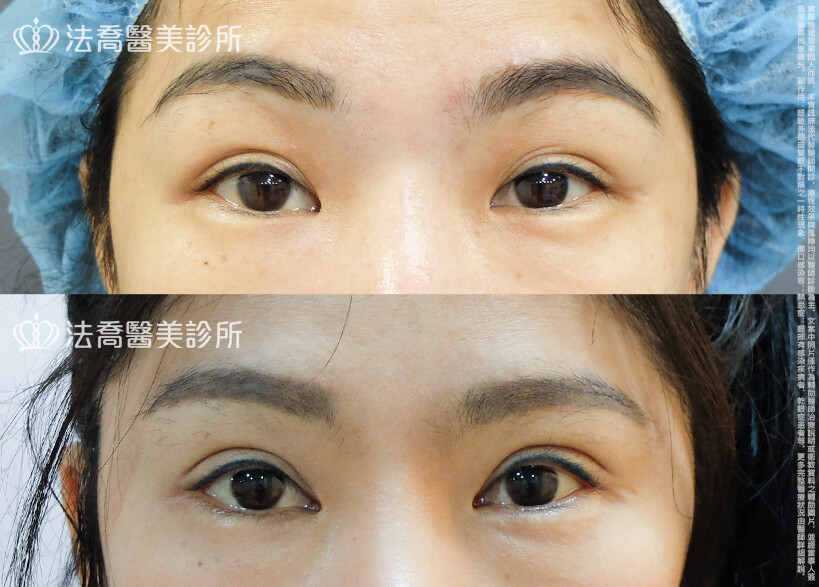 法喬醫美診所,邱浚彥,割雙眼皮,眼瞼肌提拉術,開眼頭,開眼尾