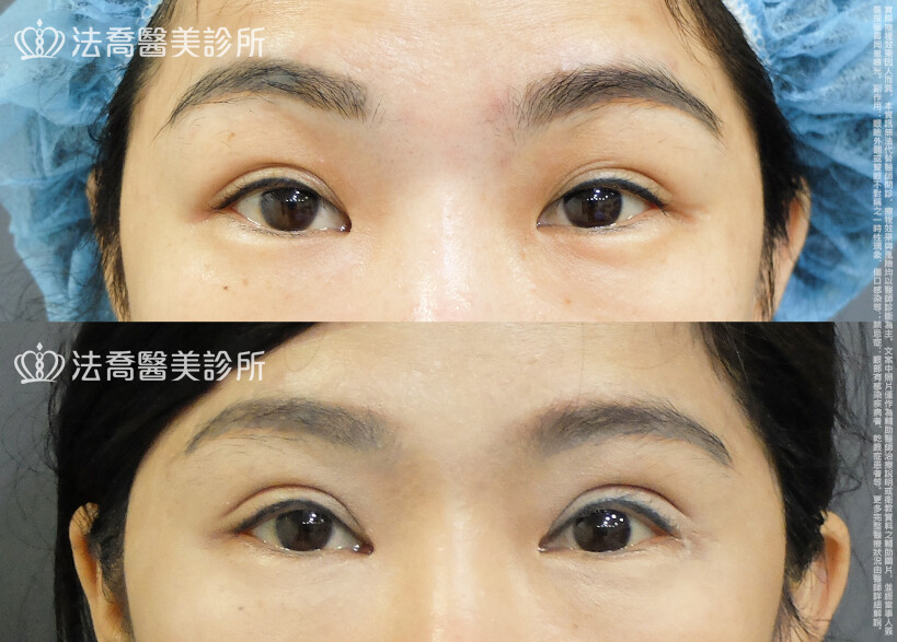 法喬醫美診所,邱浚彥,割雙眼皮,眼瞼肌提拉術,開眼頭,開眼尾