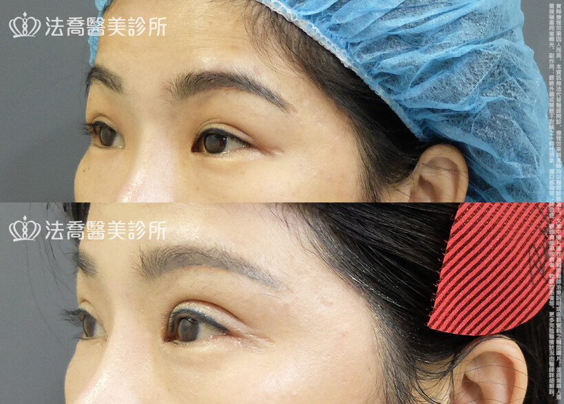 法喬醫美診所,邱浚彥,割雙眼皮,眼瞼肌提拉術,開眼頭,開眼尾