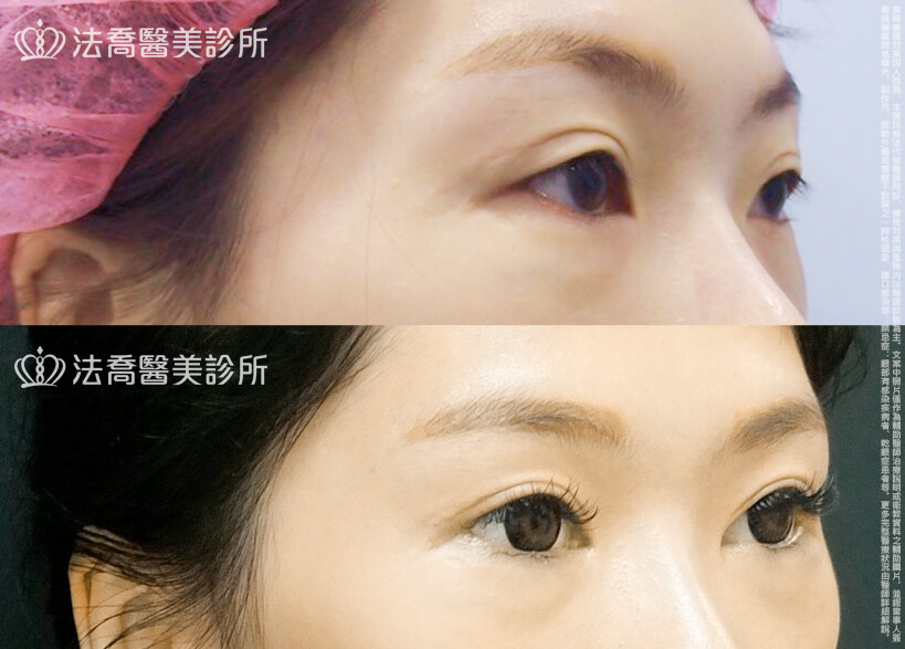 法喬醫美診所,邱浚彥,割雙眼皮,眼瞼肌提拉術,開眼頭,開眼尾