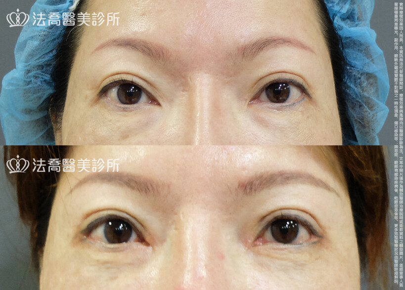 法喬醫美診所,邱浚彥,割雙眼皮,眼瞼肌提拉術