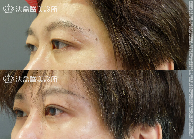 法喬醫美診所,邱浚彥,割雙眼皮,眼瞼肌提拉術