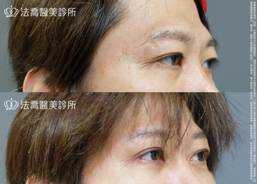 法喬醫美診所,邱浚彥,割雙眼皮,眼瞼肌提拉術