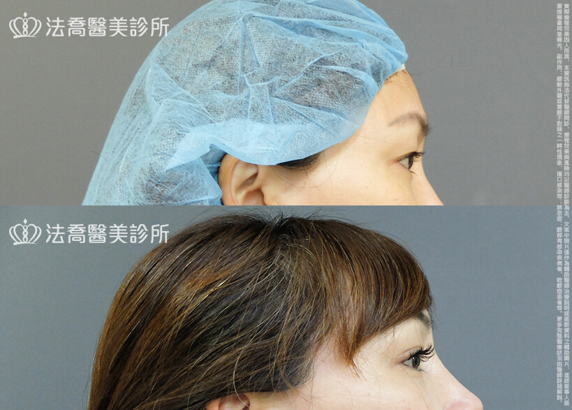 法喬醫美診所,邱浚彥,割雙眼皮,眼瞼肌提拉術