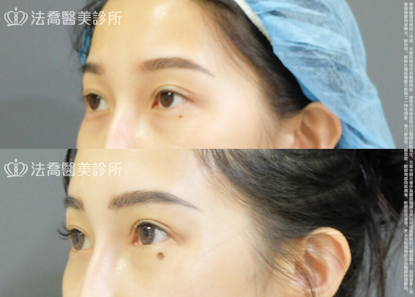 法喬醫美診所 邱浚彥醫師,割雙眼皮,眼瞼肌提拉術,開眼頭,開眼尾