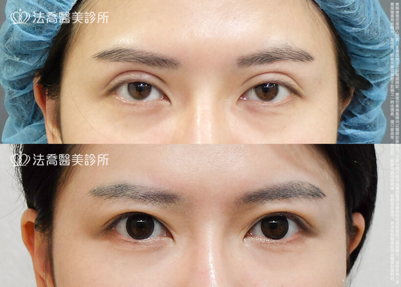 法喬醫美診所,邱浚彥,割雙眼皮,眼瞼肌提拉術