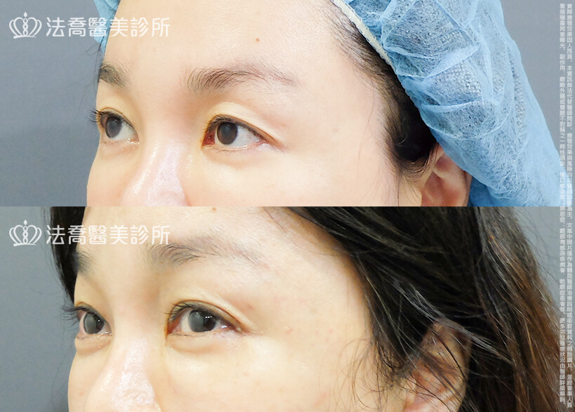 法喬醫美診所,邱浚彥,割雙眼皮