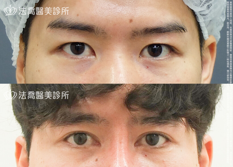 法喬醫美診所,邱浚彥,割雙眼皮