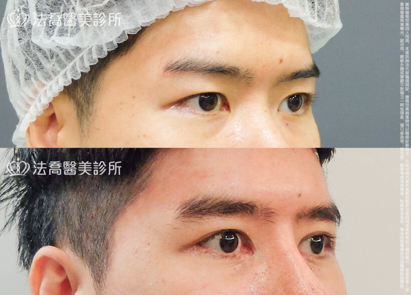 法喬醫美診所,邱浚彥,割雙眼皮