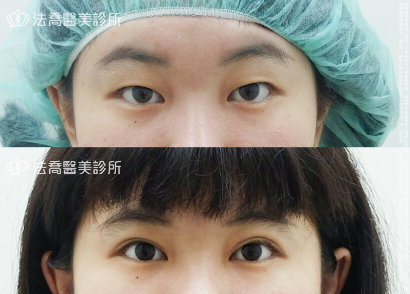 割雙眼皮