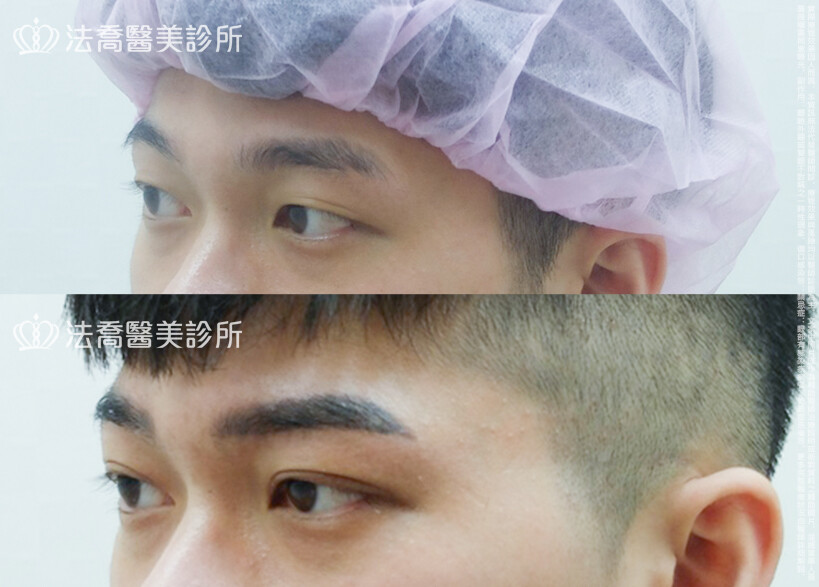 割雙眼皮